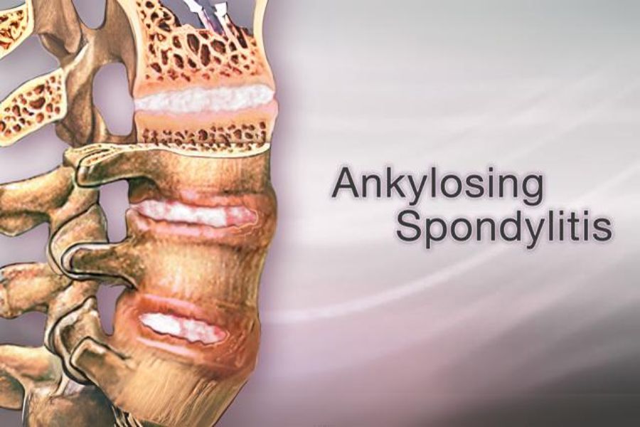Ankylosing spondylosis