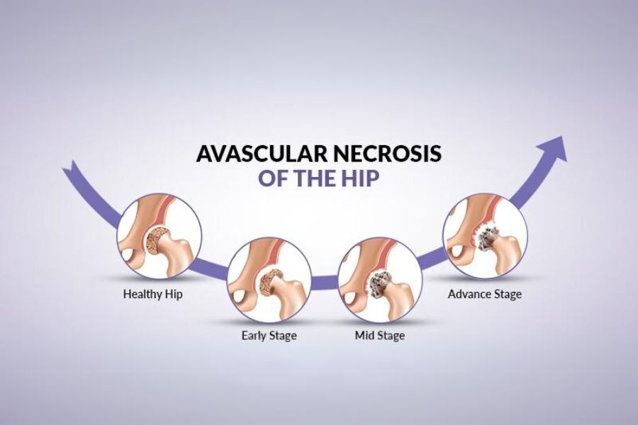 Avascular Necrosis of the Hip