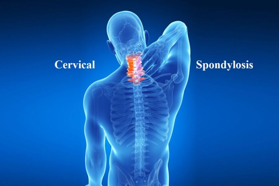 Cervical Spondylitis