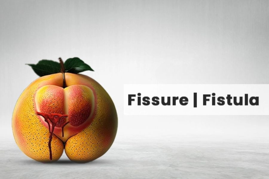 Fissure & fistula
