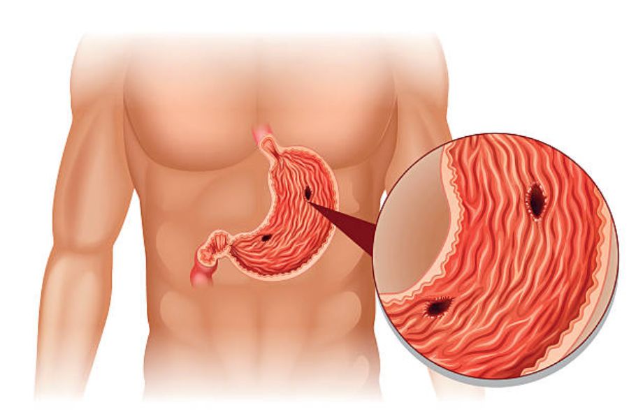 Gastric ulcer