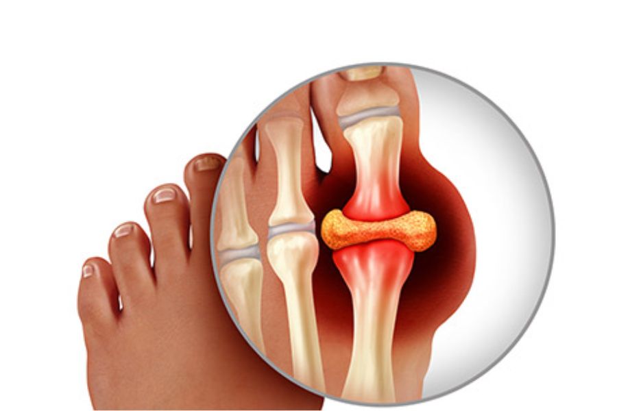 Gout