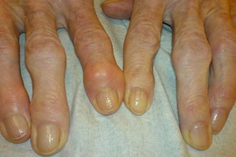 Osteoarthritis