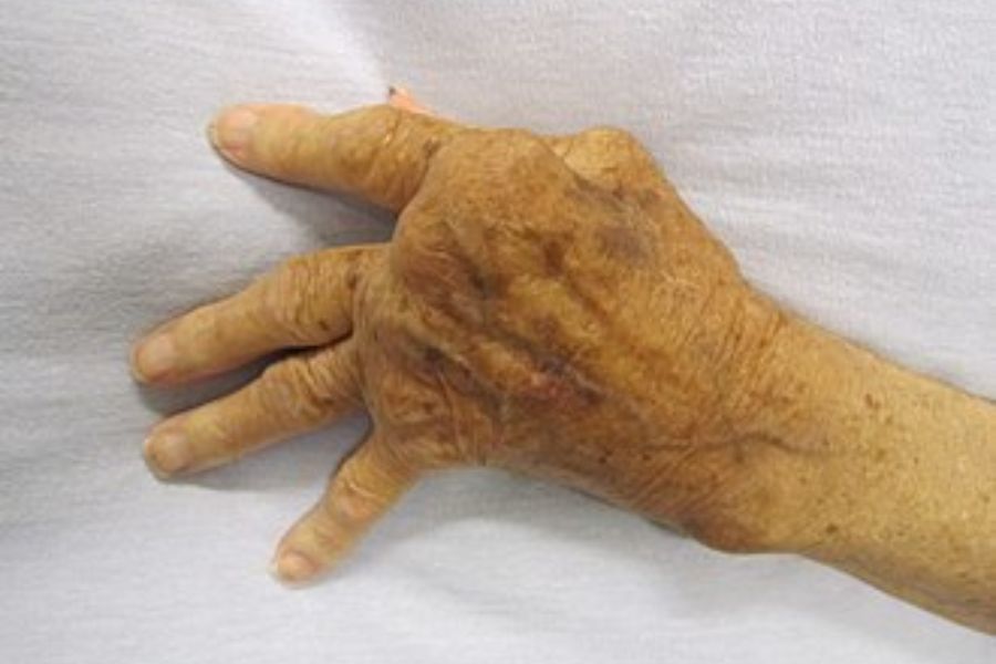 Rheumatoid Arthritis