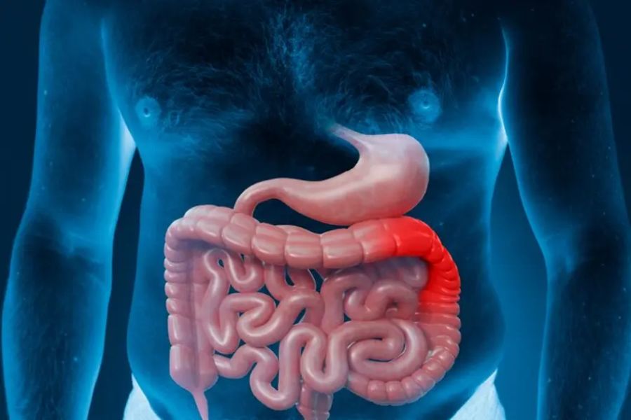 Ulcerative colitis